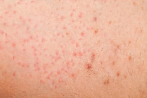 Man with razor bumps and post-shave irritation on his cheek